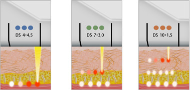 3種類のトランスデューサーで、真皮層からSMAS筋膜まで一挙にリフトアップ