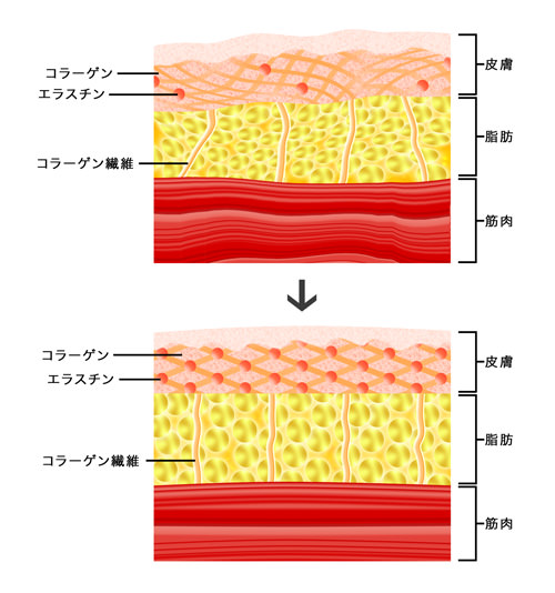 熱ダメージによる創傷治癒作用が大量のコラーゲンを生成