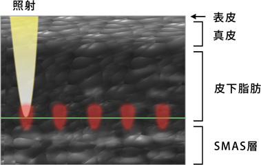モニターをチェックしながら安全で的確な照射を実現
