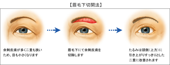 II. 眉毛下切開法