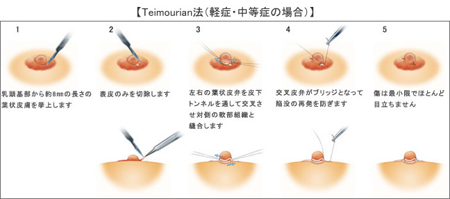 (軽症)・ (中等症)