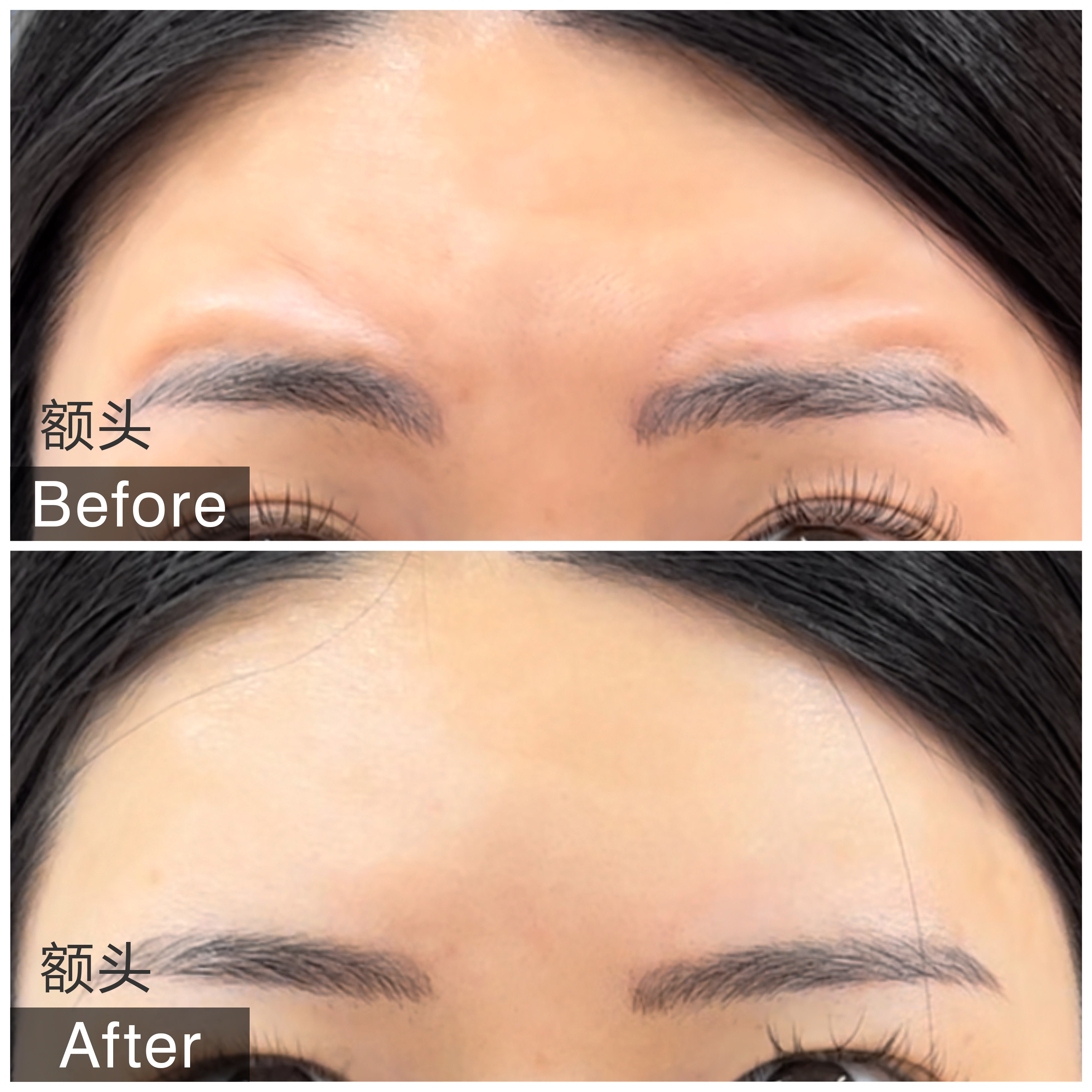 肉毒素・玻尿酸注射