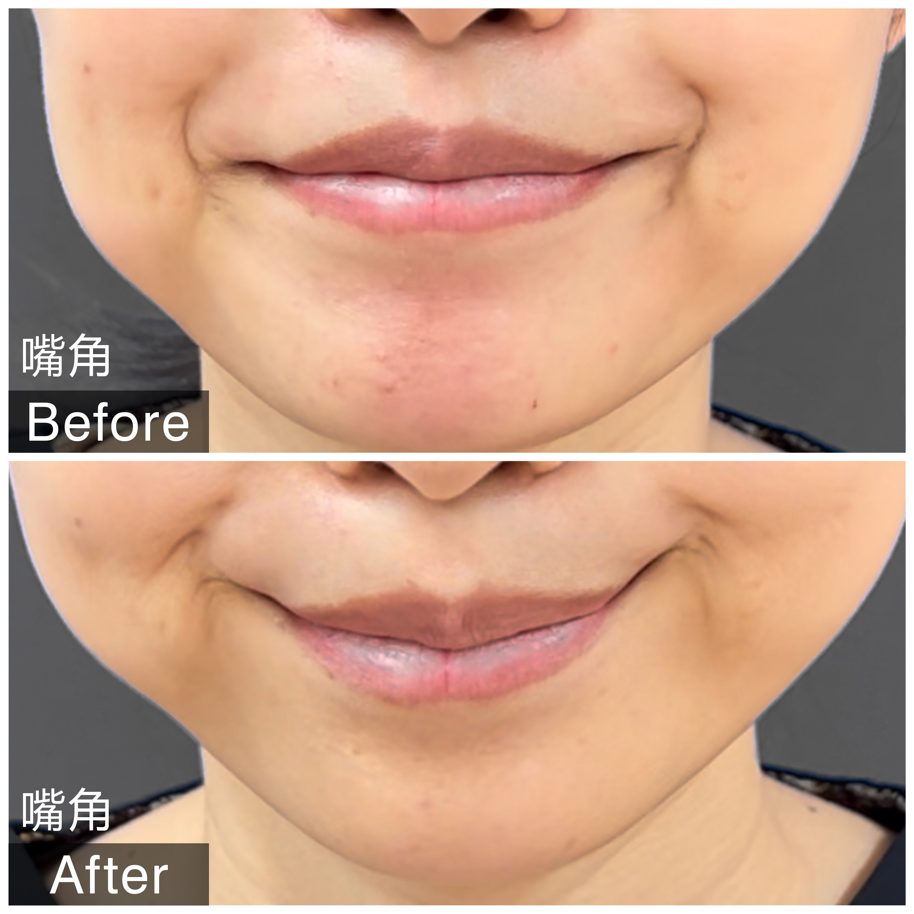 肉毒素・玻尿酸注射