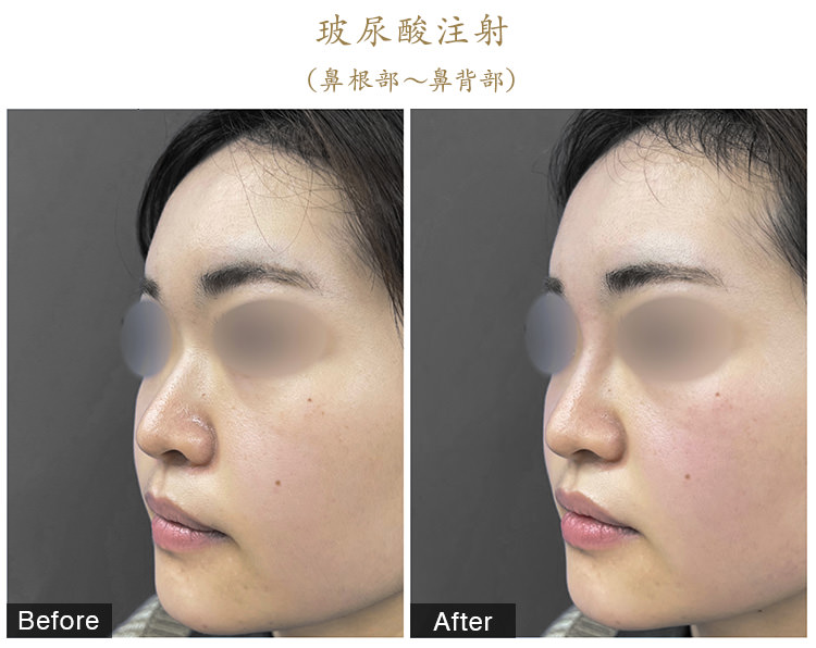 玻尿酸注射
