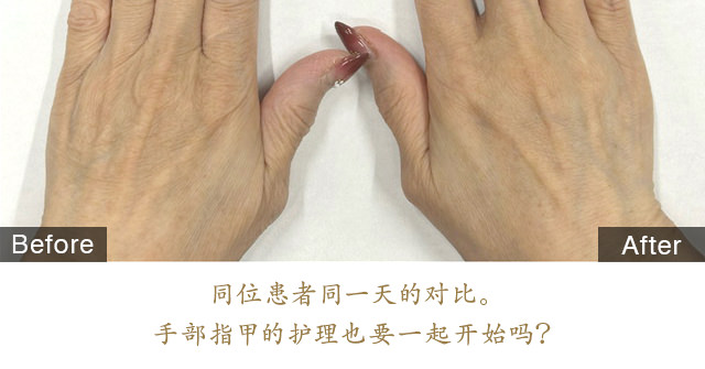 Stellar M22（光子嫩肤) 治疗内容