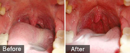 Night lase（祛鼻鼾治疗）