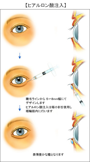ヒアルロン酸注入