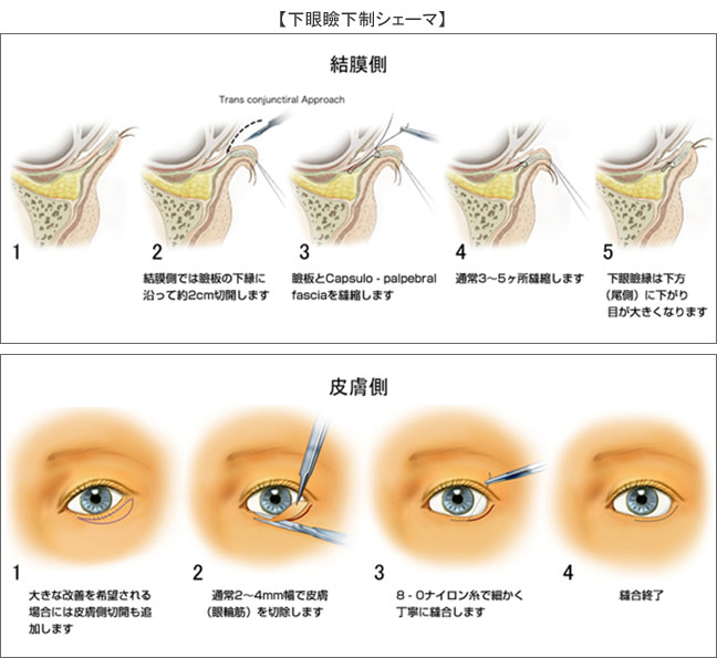 下眼瞼拡大 垂れ目形成 目 眼瞼 美容整形ならリッツ美容外科