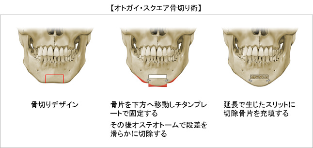 オトガイ・スクエア骨切り術(リッツ・オリジナル手術)
