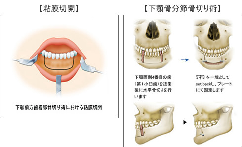1)下顎分節骨切り術の実際