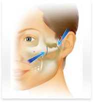 頬骨(頬骨削り)