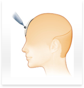 額（額増大 アパタイト・メタクリル酸メチル・脂肪・ヒアルロン酸）