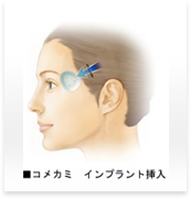 こめかみ（シリコン・アパタイト・脂肪・ヒアルロン酸）