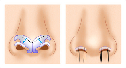 【鼻孔縁鼻翼軟骨移植術】