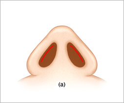 【鼻孔縁複合組織移植術】