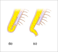 【鼻孔縁複合組織移植術】