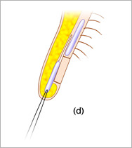 【鼻孔縁複合組織移植術】