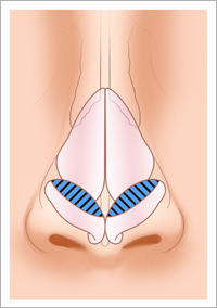 一般のクリニックで行われている鼻尖形成術の問題点