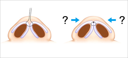 リッツ式鼻尖縮小術