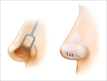 【鼻柱挙上術】