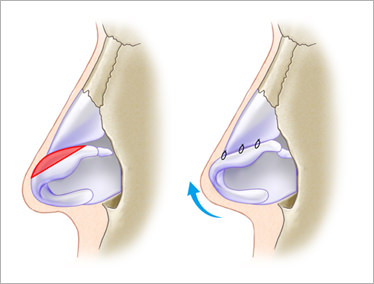 【鼻柱挙上術】