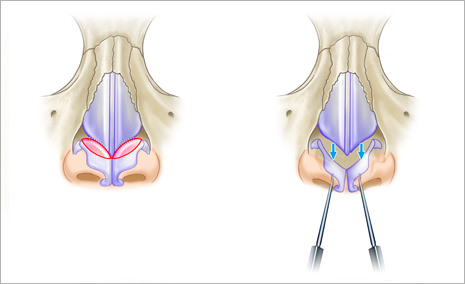 ②鼻翼軟骨頭側切除