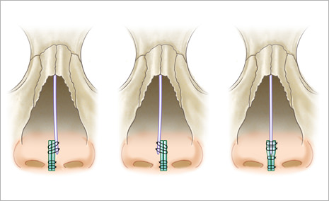 ③鼻中隔軟骨剥離