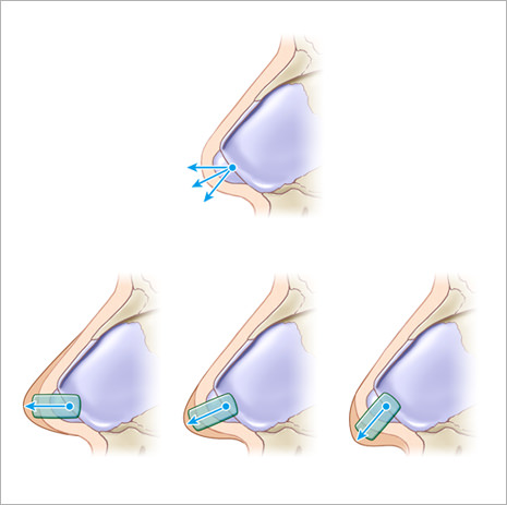 ⑤鼻翼軟骨中間脚縫合
