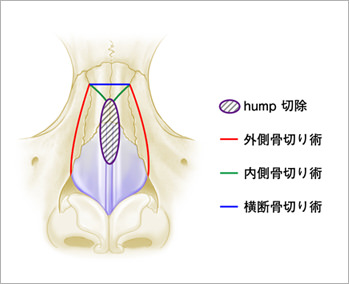鼻骨骨切り術