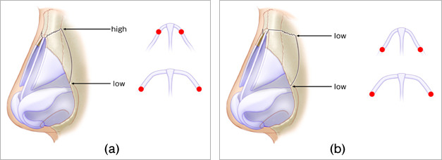 外側骨切りの際のラインに関して