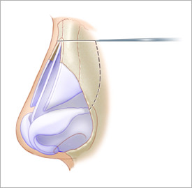 Ⅲ. 横断骨切り(transverse osteotomy)