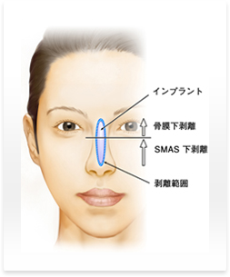 鼻プロテーゼ（シリコンインプラント）