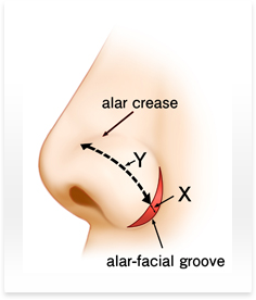 鼻翼縮小術