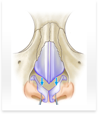 鼻尖、鼻柱延長術