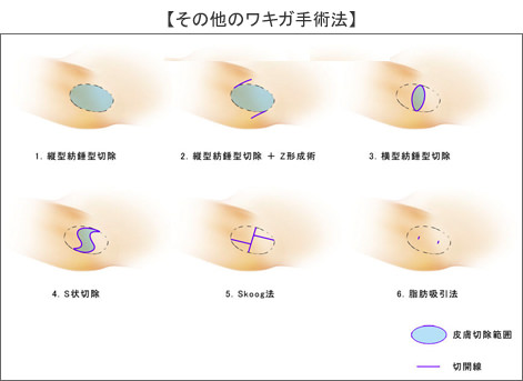 その他の手術方法