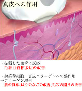 ライムライトの効果