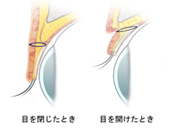 3点固定法断面図