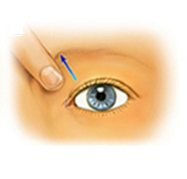 目頭切開
