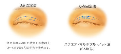 独自の埋没法